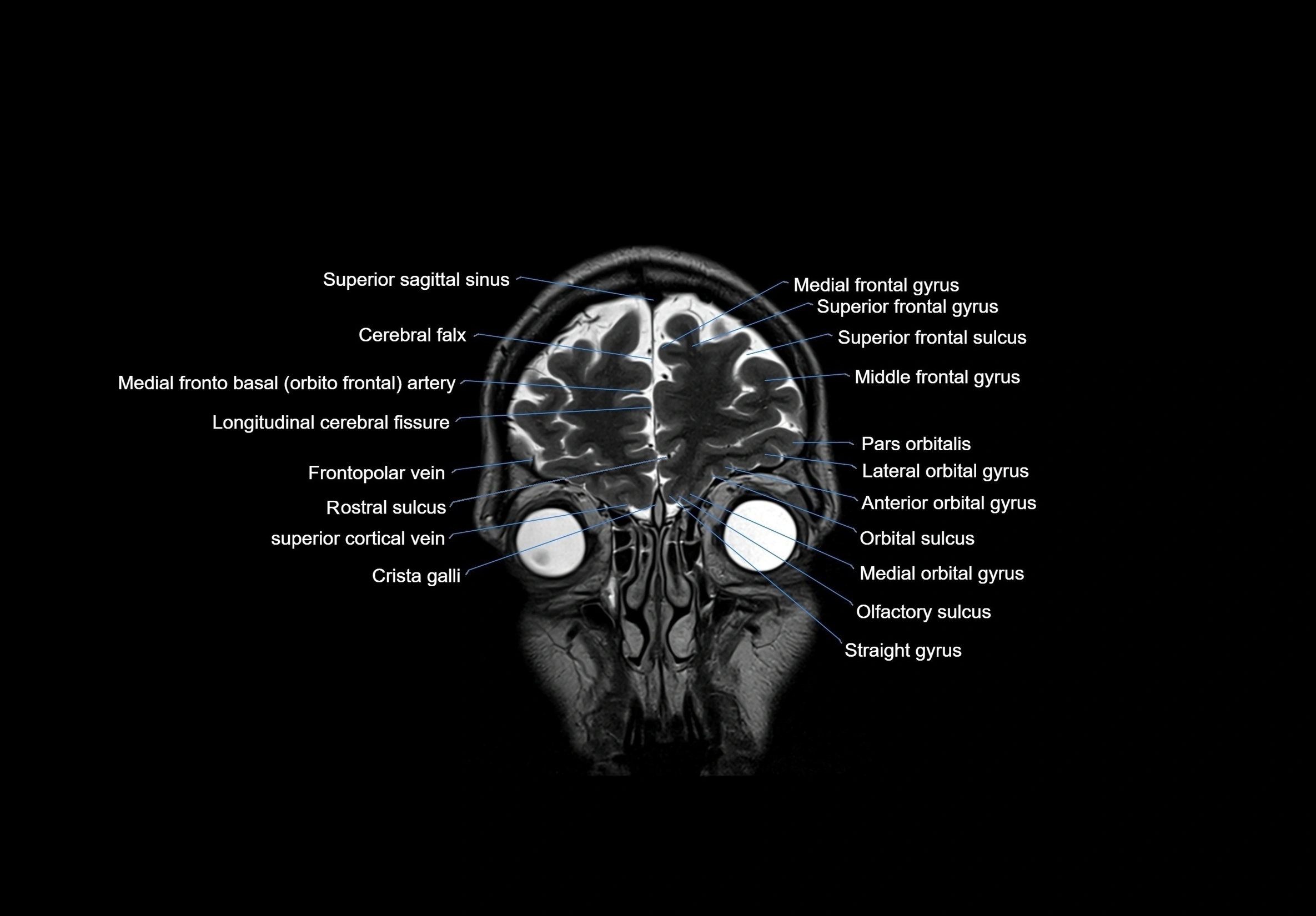 MRI Brain coronal cross sectional labelled anatomy 3T image  -img-00001-00011.webp
